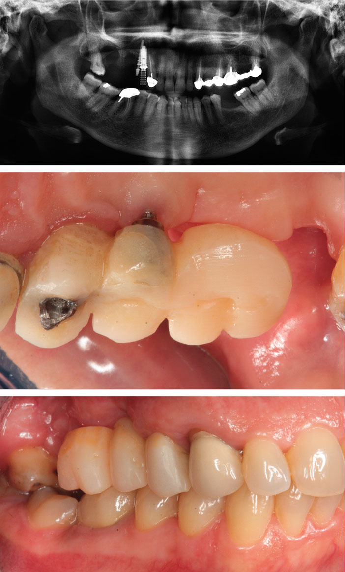 extraction-implantation