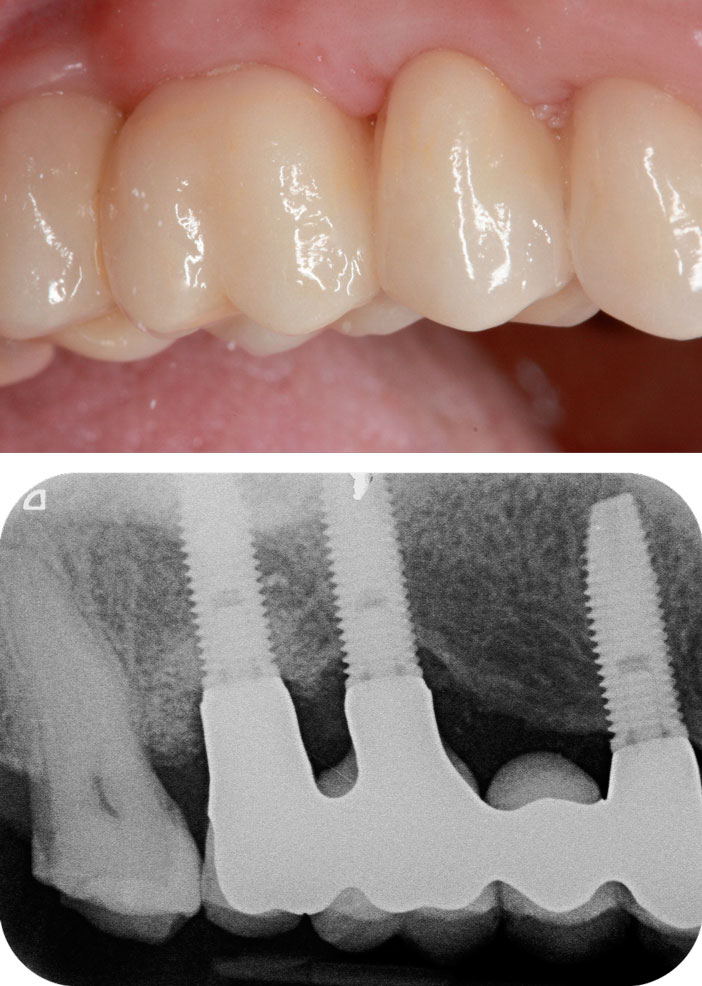 forme-des-embrasures-gingivales