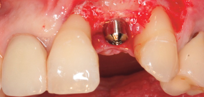 la greffe d-apposition dans le secteur esthetique