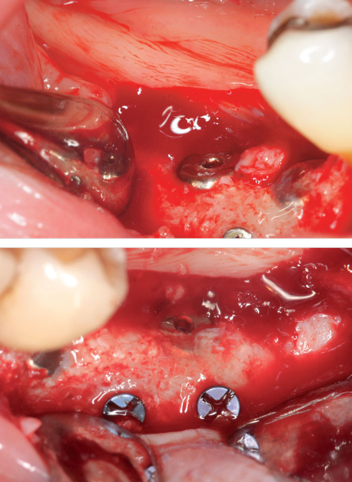 ossification-importante-du-biomateriau