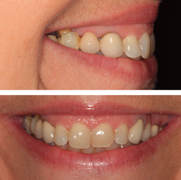 reconstruction-du-prolongement-du-mur-gingival