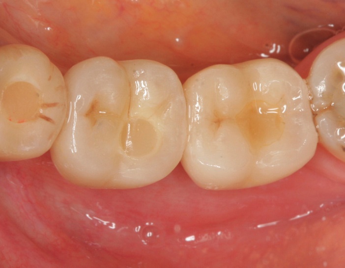 vue occlusale de la restauration sur les implants