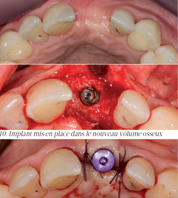 Implant-mis-en-place-dans-le-nouveau-volume-osseux