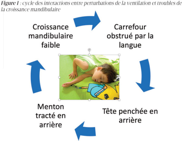 Détecter le syndrome d'apnée obstructive du sommeil chez l’enfant