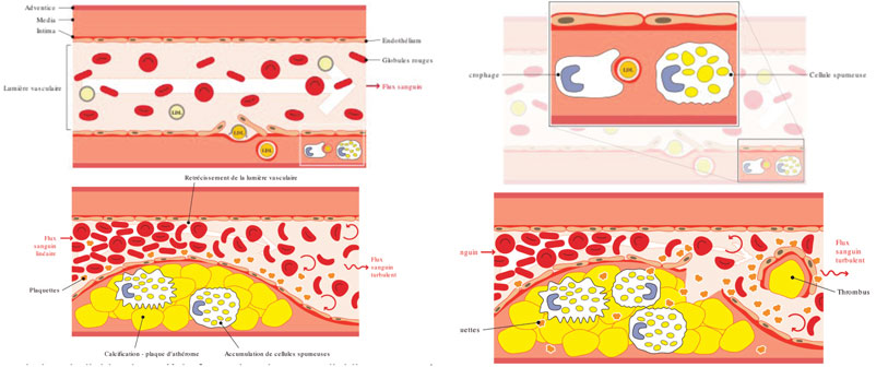 etapes-de-la-formation-d-une-plaque-d-atherom