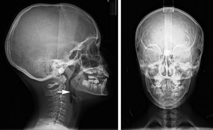 teleradiographie-de-profil-montrant-des-amygdales-volumineuses