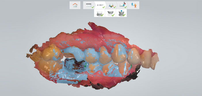 Le-calage-de-l-occlusion-est-automatique