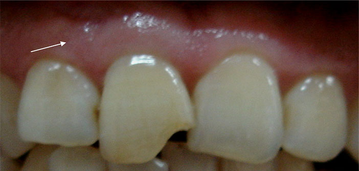 fracture-amelo-dentinaire-de-l-angle-mesial