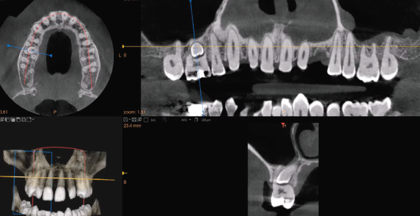 imagerie 3D fosses nasales