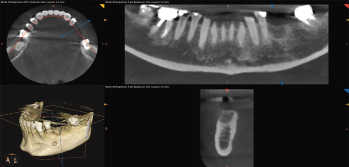 la-pose-d-implant