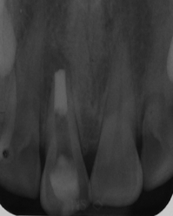 radiographie de controle prise apres mise en place du MTA