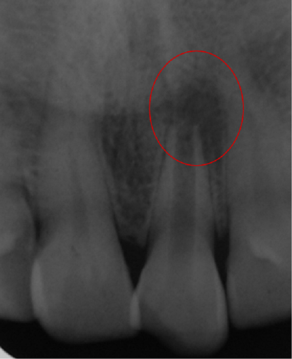 radiographie revelant la presence d’une lesion periapicale