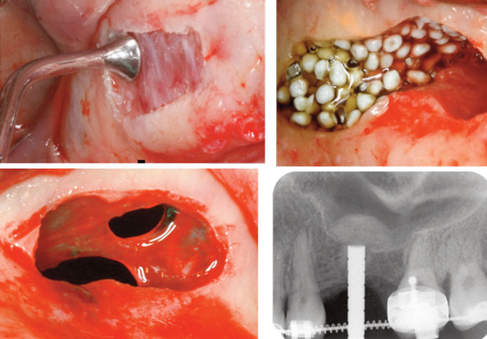 Approche-minimale-invasive