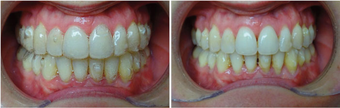 aligneurs-Invisalign-avec-taquets