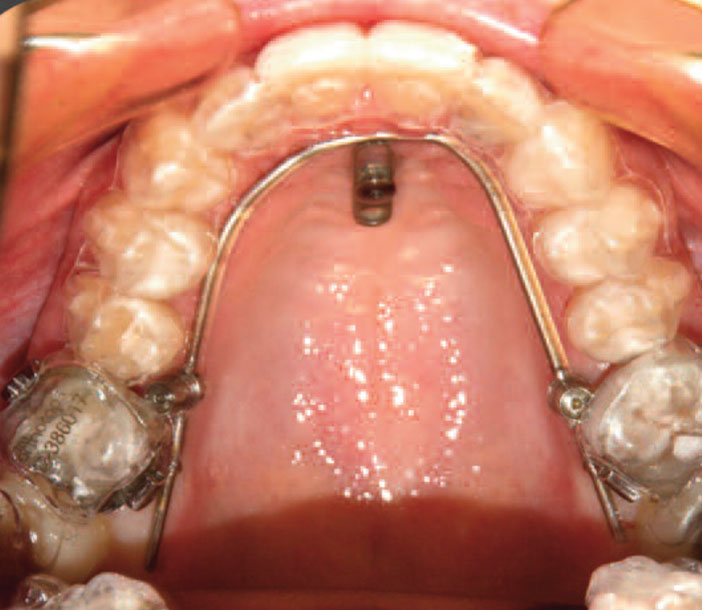 aligneurs-Orthocaps-in-situ