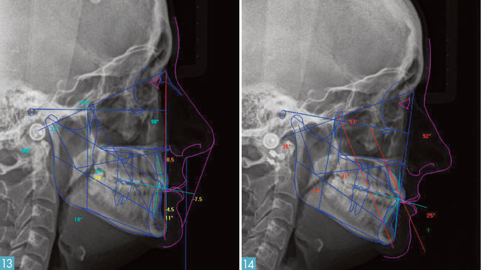 attaches-orthodontiques