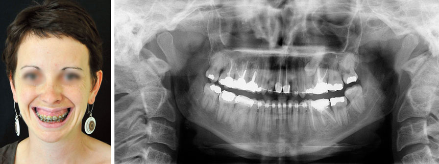 correction-son-sourire-gingival