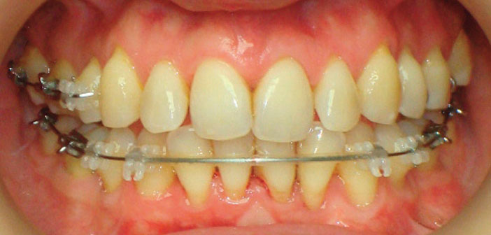 gerer-les-subtilites-anatomiques-du-traitement-orthodontique-de-l-adulte