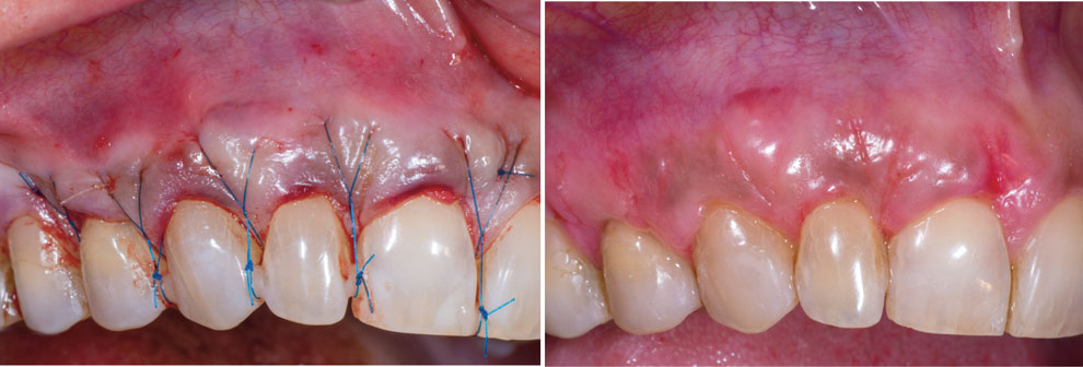 les-sutures-suspendues