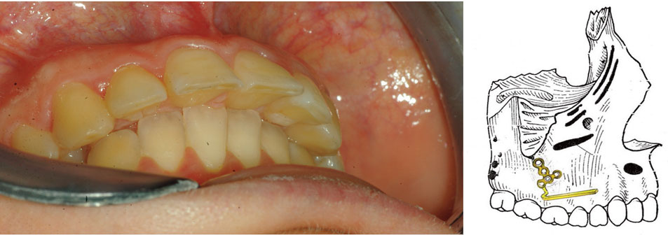 malocclusion-asymetrique-gauche