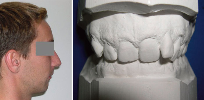 malocclusion-de-class-2-profil-fuyant