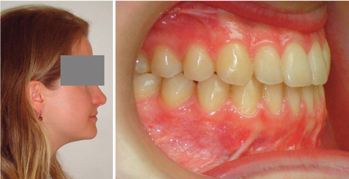 occlusion-et-profil-en-fin-de-traitement