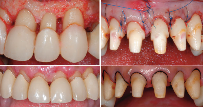 ostectomie-et-osteoplastie