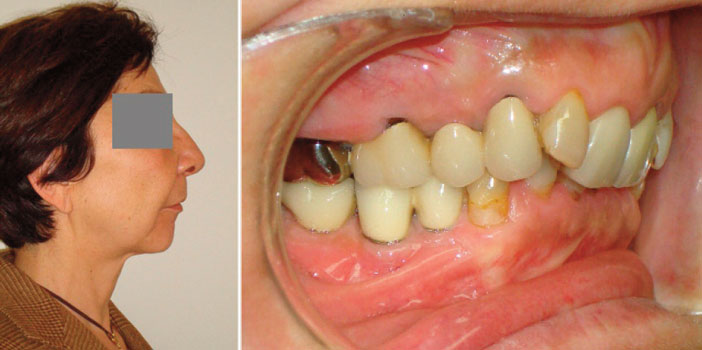 profil-fuyant-malocclusion