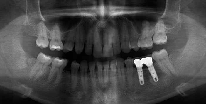 radiographie-panoramique-initiale