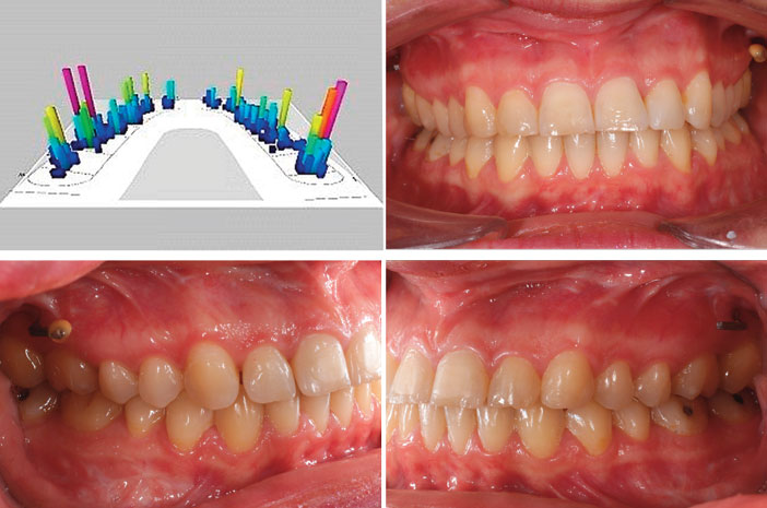 resultat-final-en-occlusion