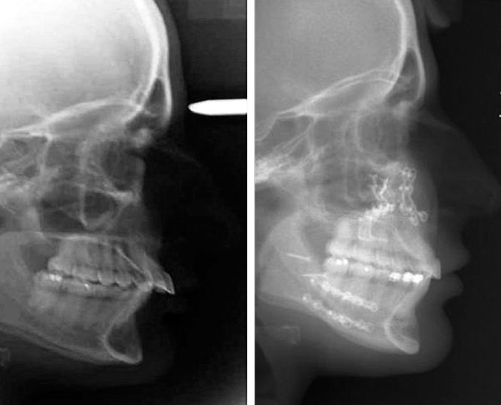 resultat-radiographique-de-la-resolution