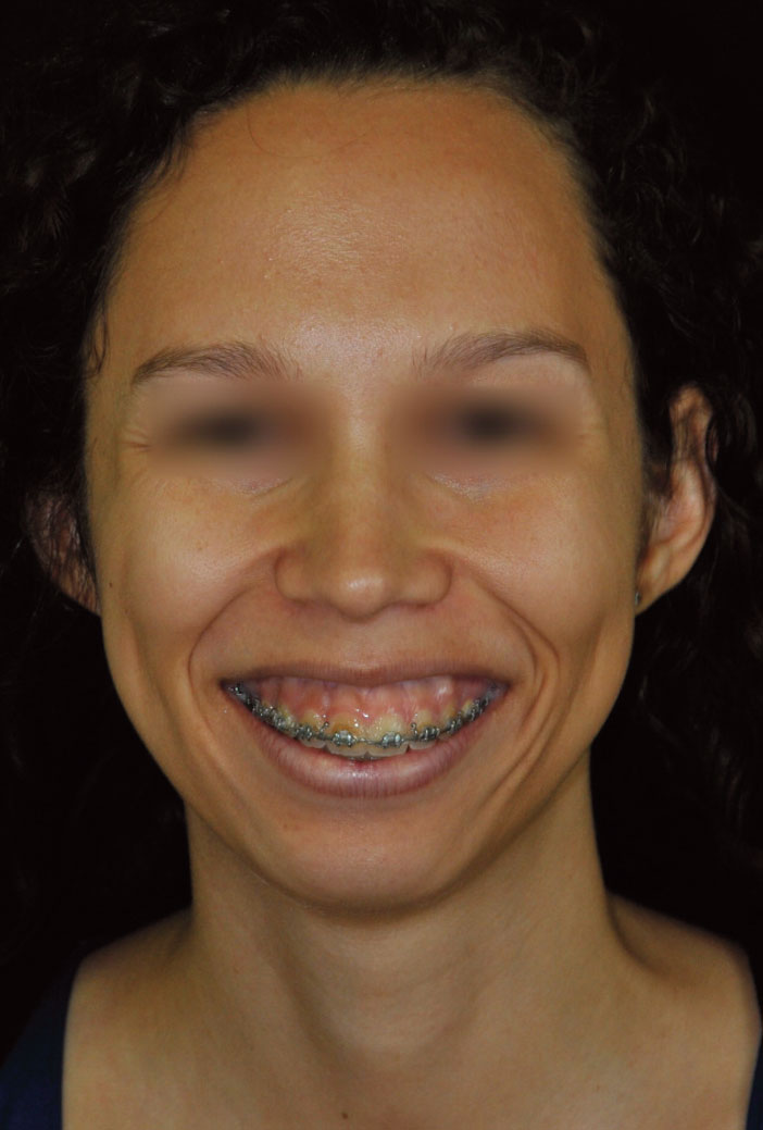 sourire-gingival