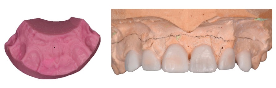 cires de diagnostic et cle en silicone