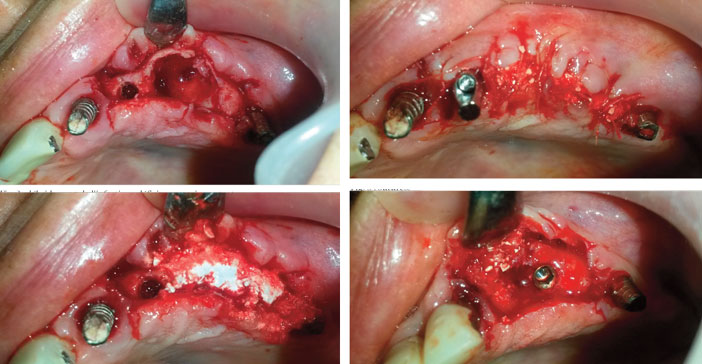 debridement-de-l-infection