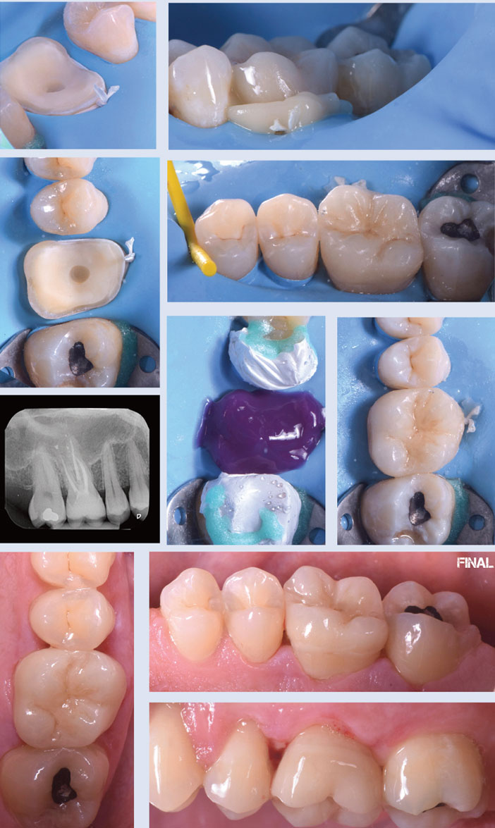 depose-de-la-restauration-transitoire