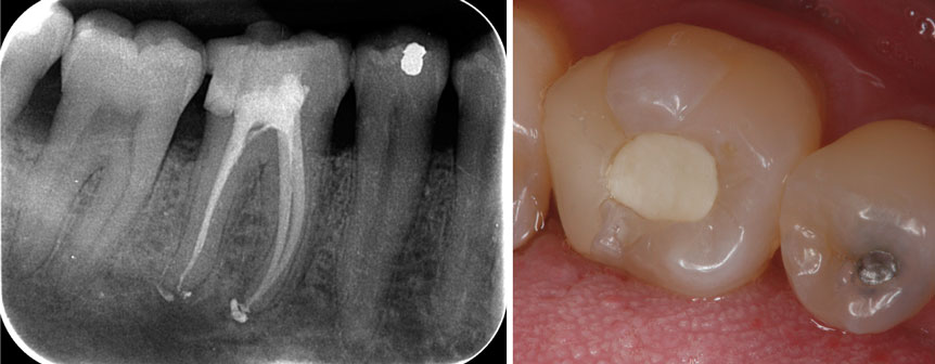 radiographie-du-traitement-endodontique