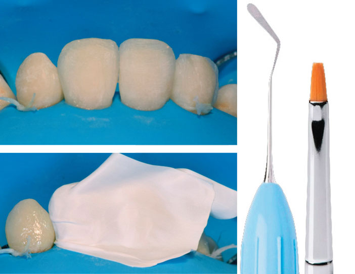 stratification-de-la-masse-dentine