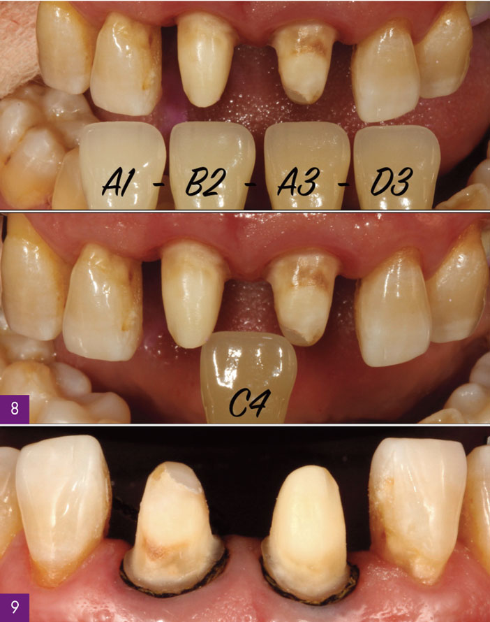 teinte-des-dents