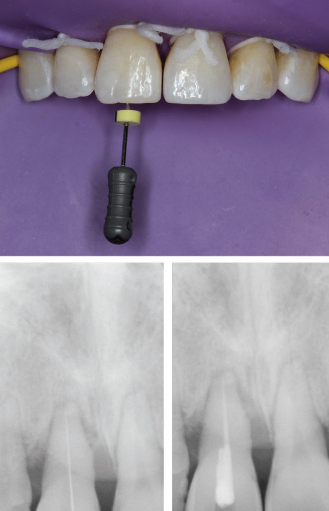 3 Bouchons Endodontiques Dentaires - Qualité Haute, Tailles S+M+L, 3 Couleurs, Pour Obturation Manuelle