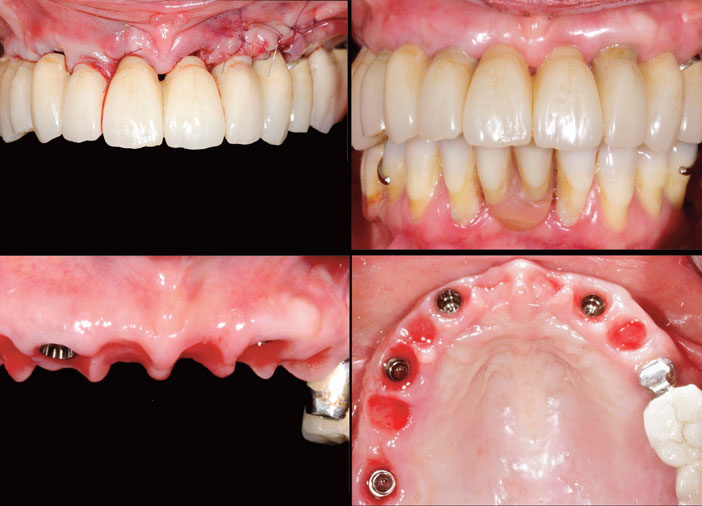 cicatrisation-et-maturation-gingivale