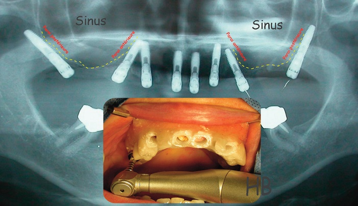 contourner le sinus grace a la chirurgie guidee