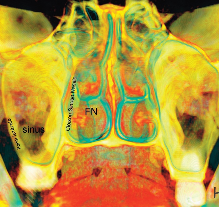 coupe Frontale et cloison Sinuso-Nasale