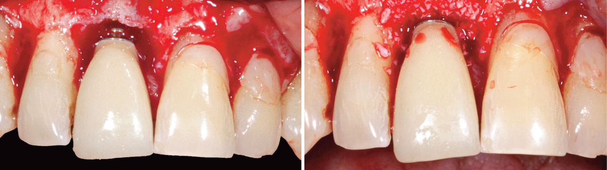 dent-provisoire-transvissee