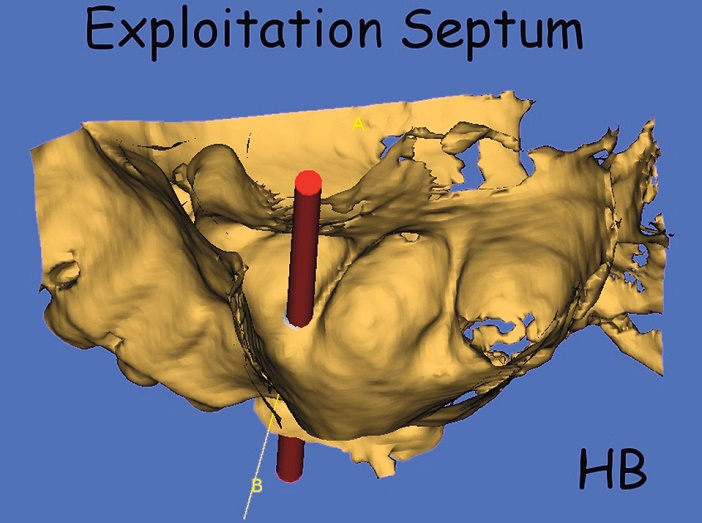 exploitation 3D d-une des 2 cloisons de refend