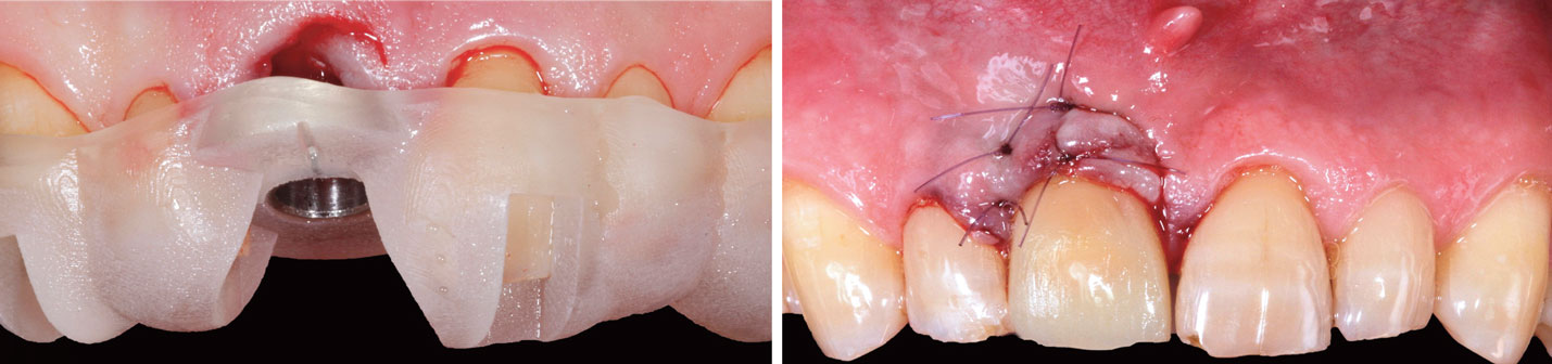 guide-chirurgical