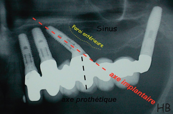 implant angule