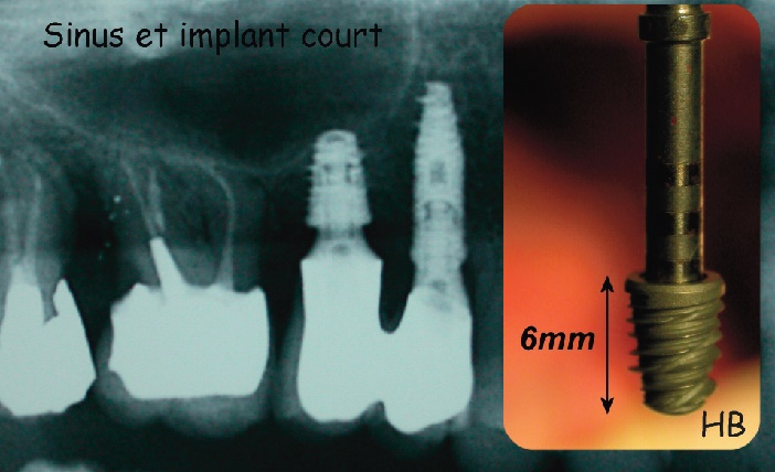 implant court sous sinusien