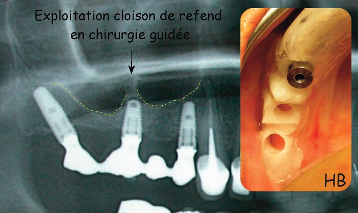 implant positionne dans une cloison