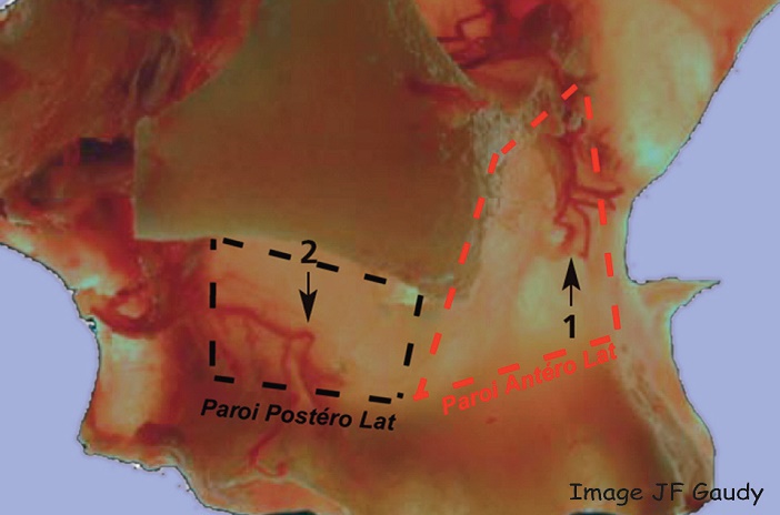 paroi anterieure ou antero-laterale