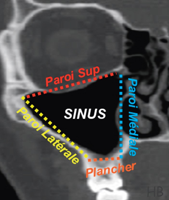 parois du sinus maxillaire